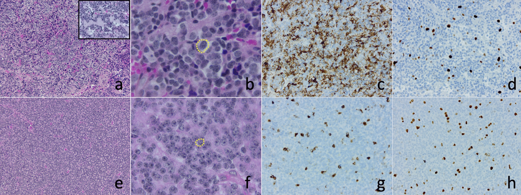 Pineal parenchymal tumors of intermediate differentiation: in need of a stringent definition to avoid confusion. Scientific commentary on ‘Genetical and epigenetical profiling identifies two subgroups of pineal parenchymal tumors of intermediate differentiation (PPTID) with distinct molecular, histological and clinical characteristics’