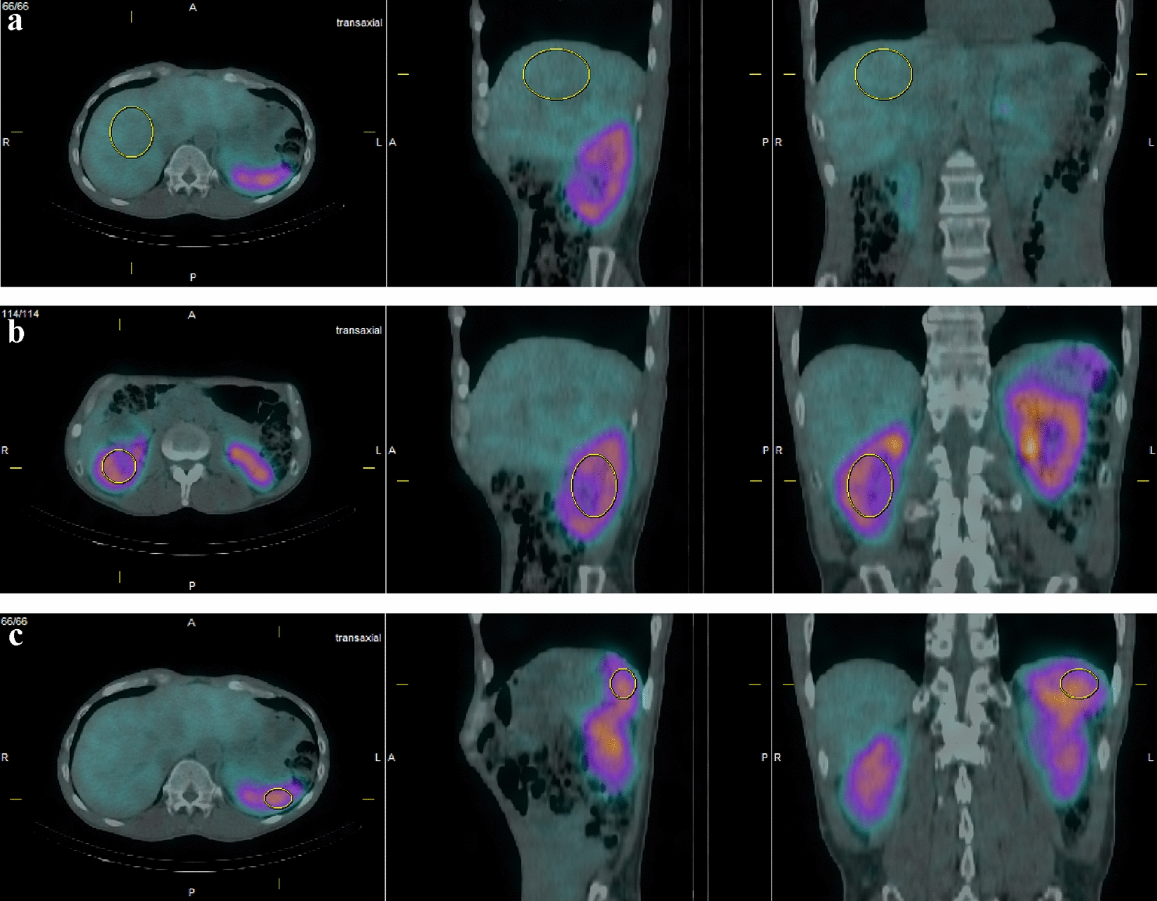 Combined visual and quantitative assessment of somatostatin receptor scintigraphy for staging and restaging of neuroendocrine tumors