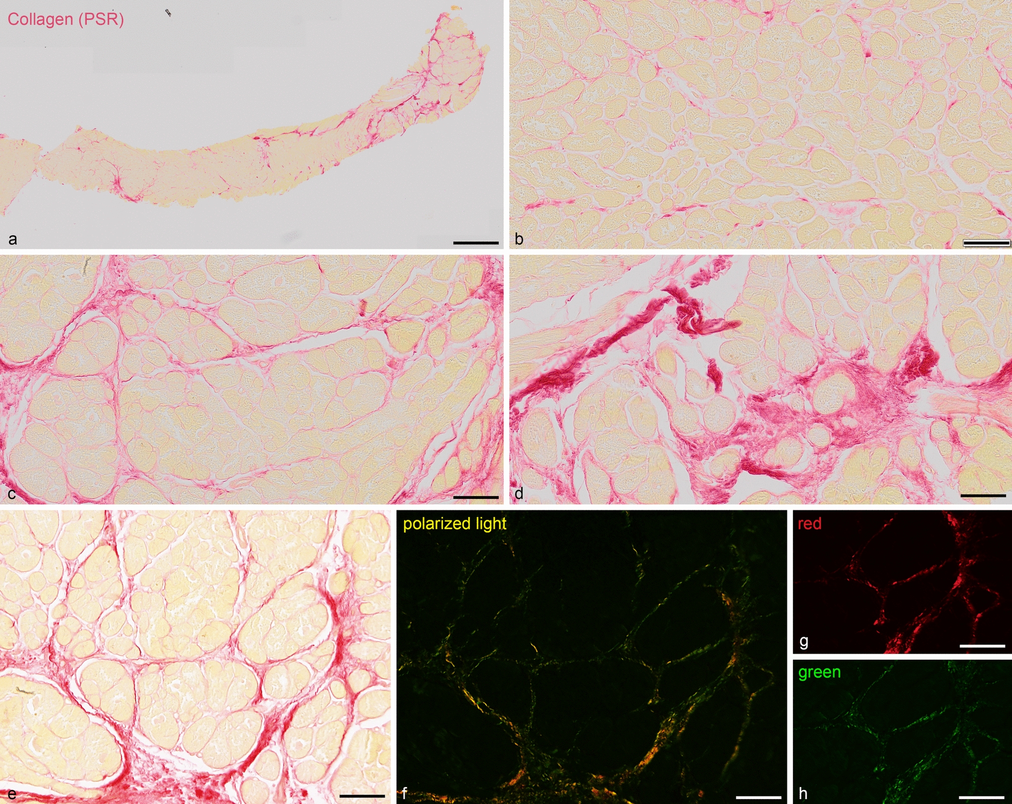 Fibrosis and expression of extracellular matrix proteins in human interventricular septum in aortic valve stenosis and regurgitation