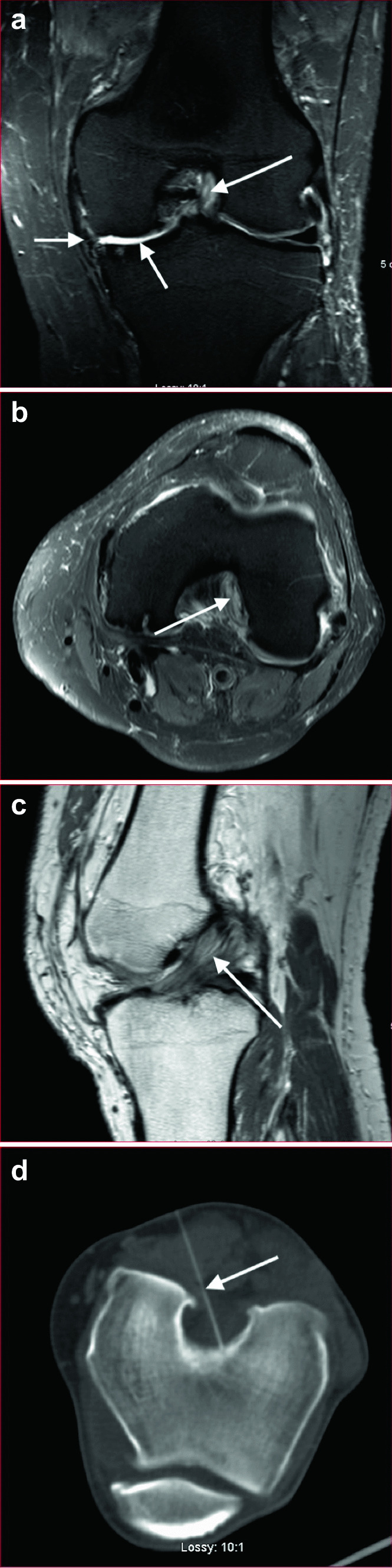 Percutaneous image-guided treatment of mucoid degeneration of the ACL in advanced knee osteoarthritis—Preliminary observations