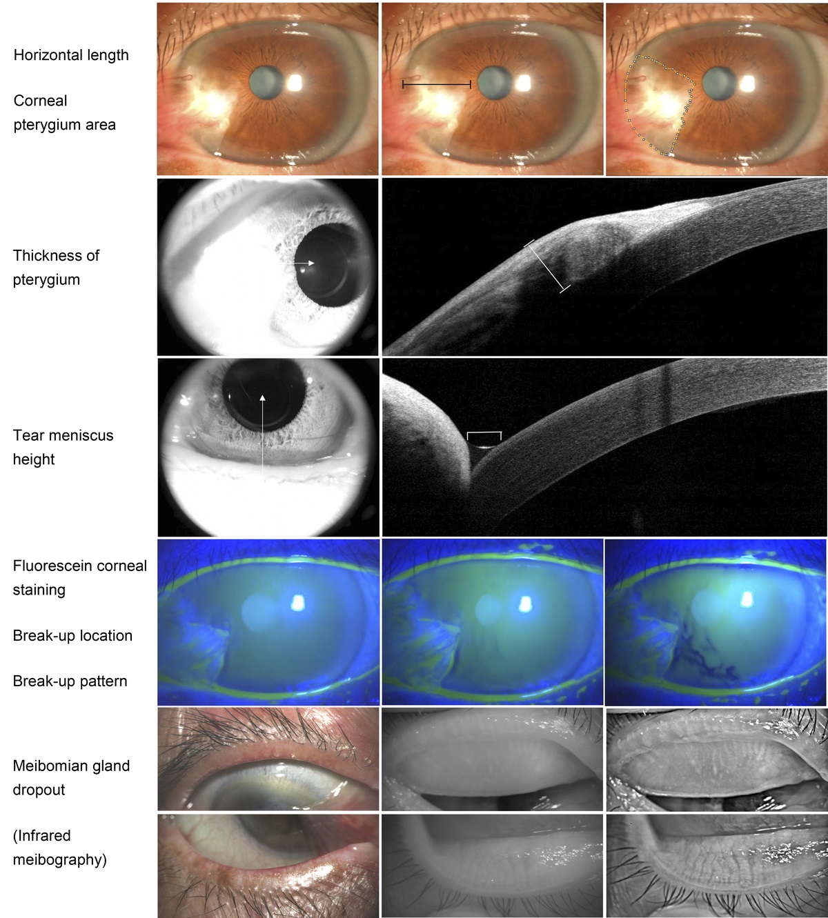The unique properties of tear film breakup process in patients with nasal unilateral pterygium