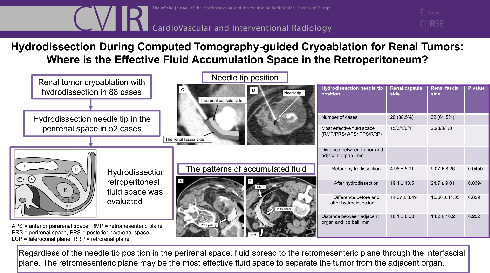 Hydrodissection During Computed Tomography-Guided Cryoablation for Renal Tumors: Where is the Effective Fluid Accumulation Space in the Retroperitoneum?