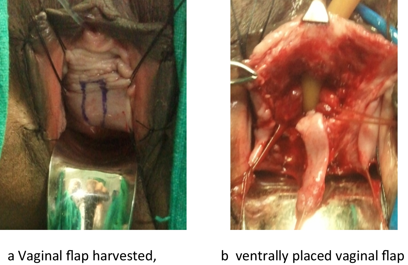 Substitution Urethroplasty in Female Urethral Stricture — Our Initial Experience