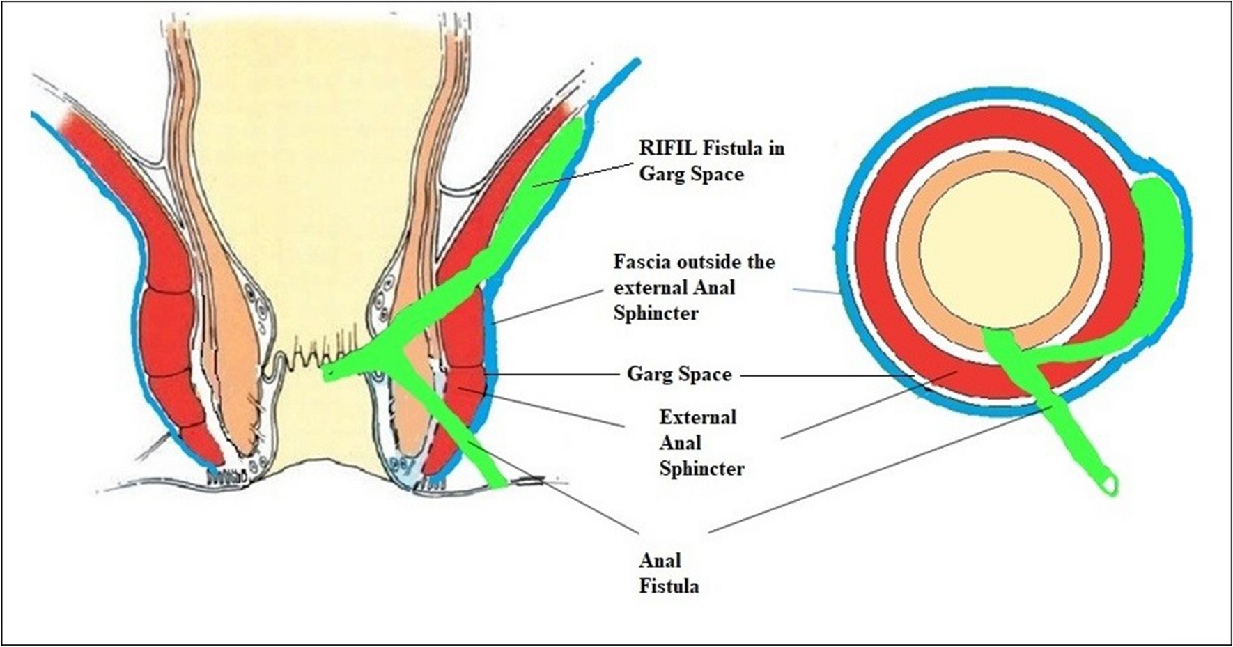 Recent Advances in the Understanding and Management of Anal Fistula from India