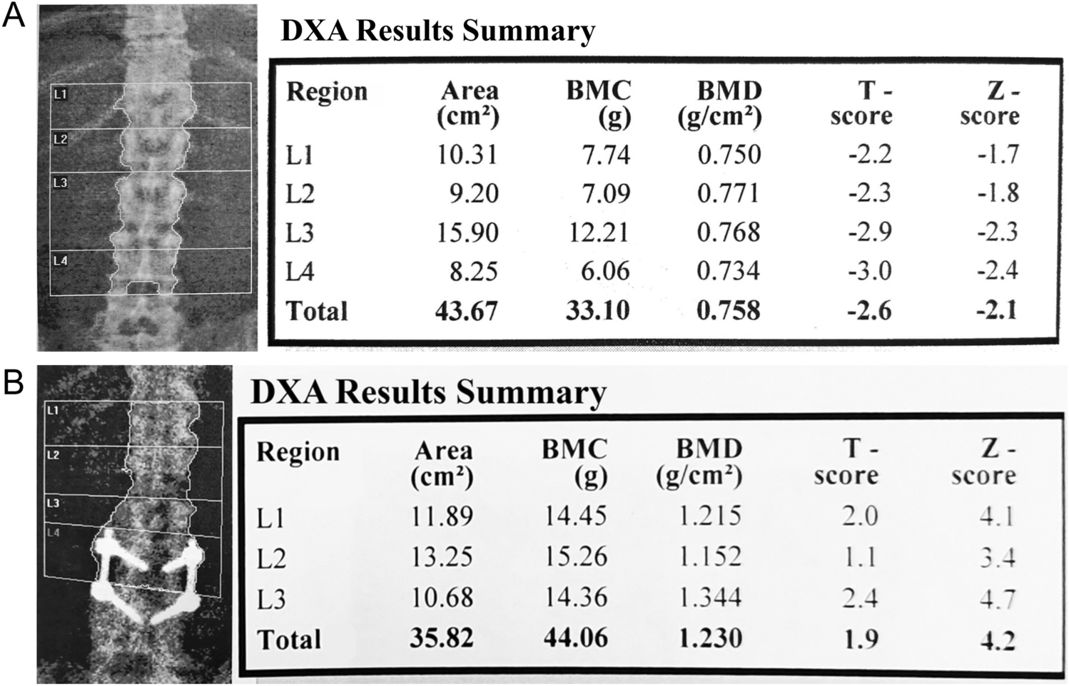 Bone densitometry in Thalassemia major: a closer look at pitfalls and operator-related errors in a 10-year follow-up population