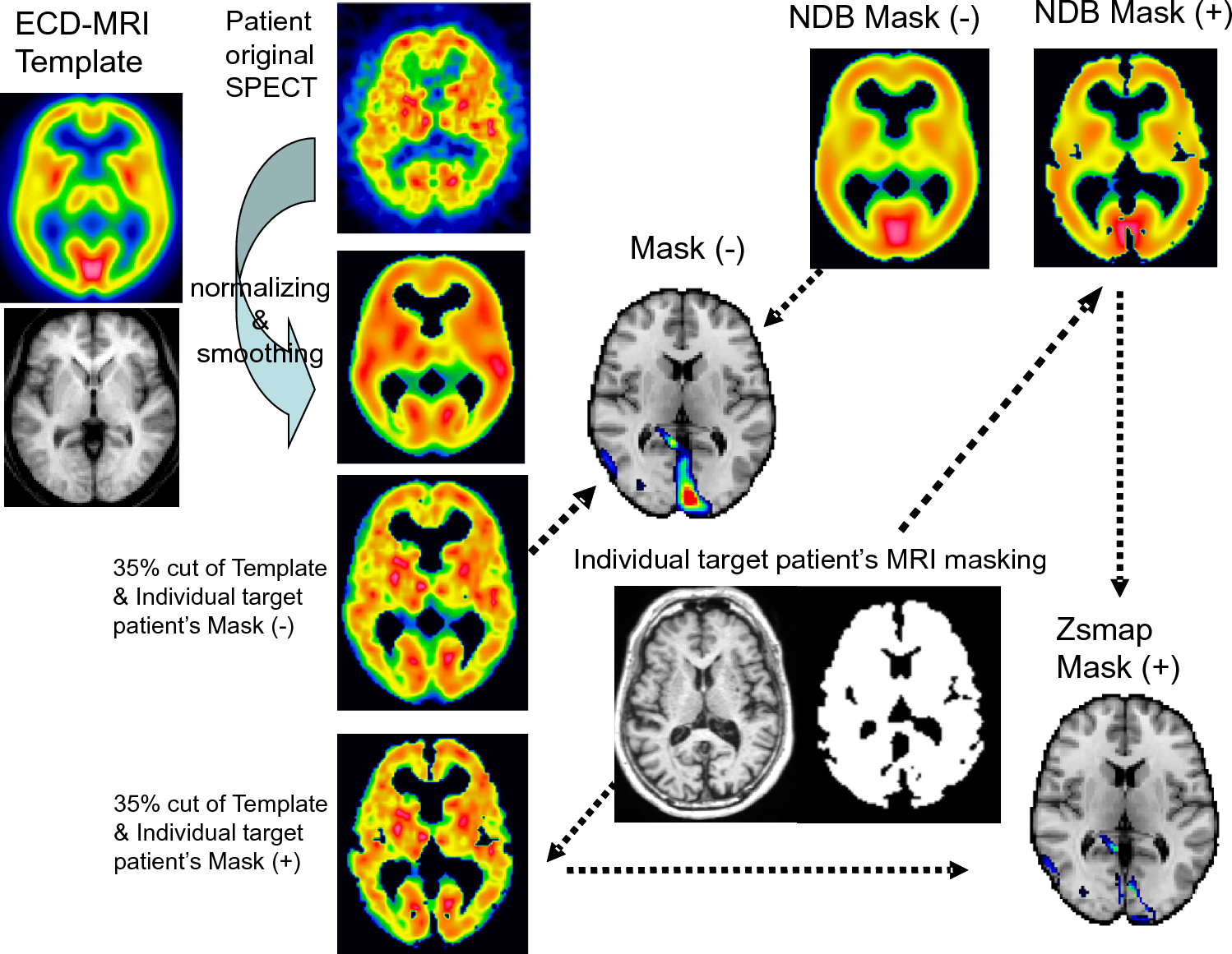 Diagnostic approach with Z-score mapping to reduce artifacts caused by cerebral atrophy in regional CBF assessment of mild cognitive impairment (MCI) and Alzheimer's disease by [99mTc]-ECD and SPECT