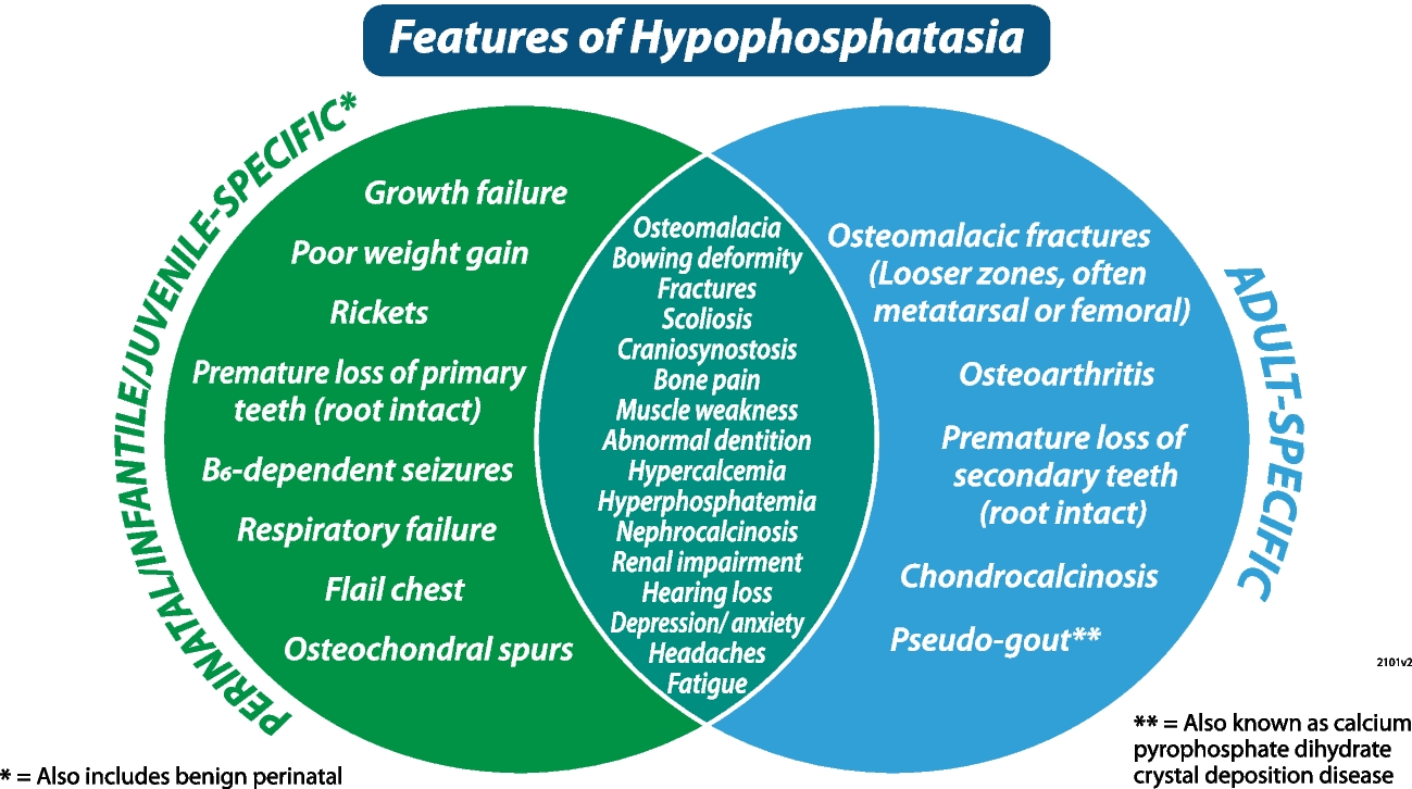 Hypophosphatasia diagnosis: current state of the art and proposed diagnostic criteria for children and adults
