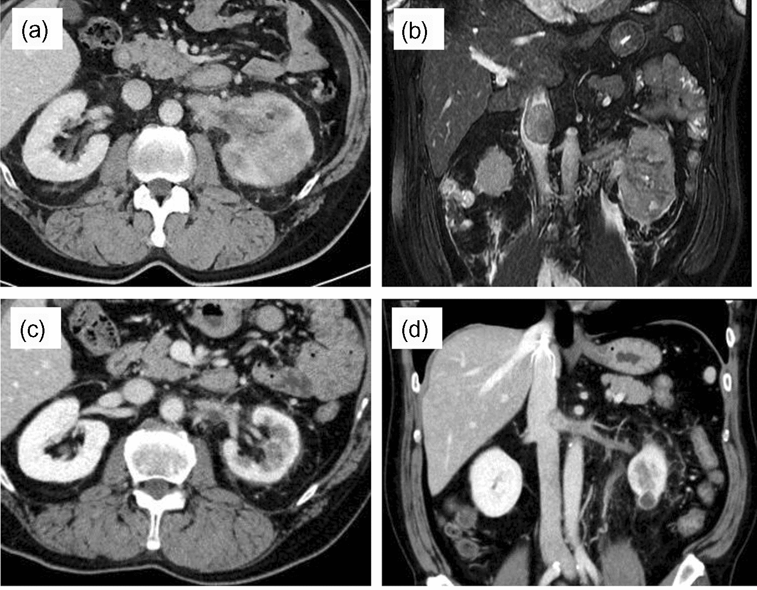 A case of postoperative pancreatitis in patients with renal cell carcinoma with an inferior vena cava tumor thrombus treated by presurgical lenvatinib plus pembrolizumab