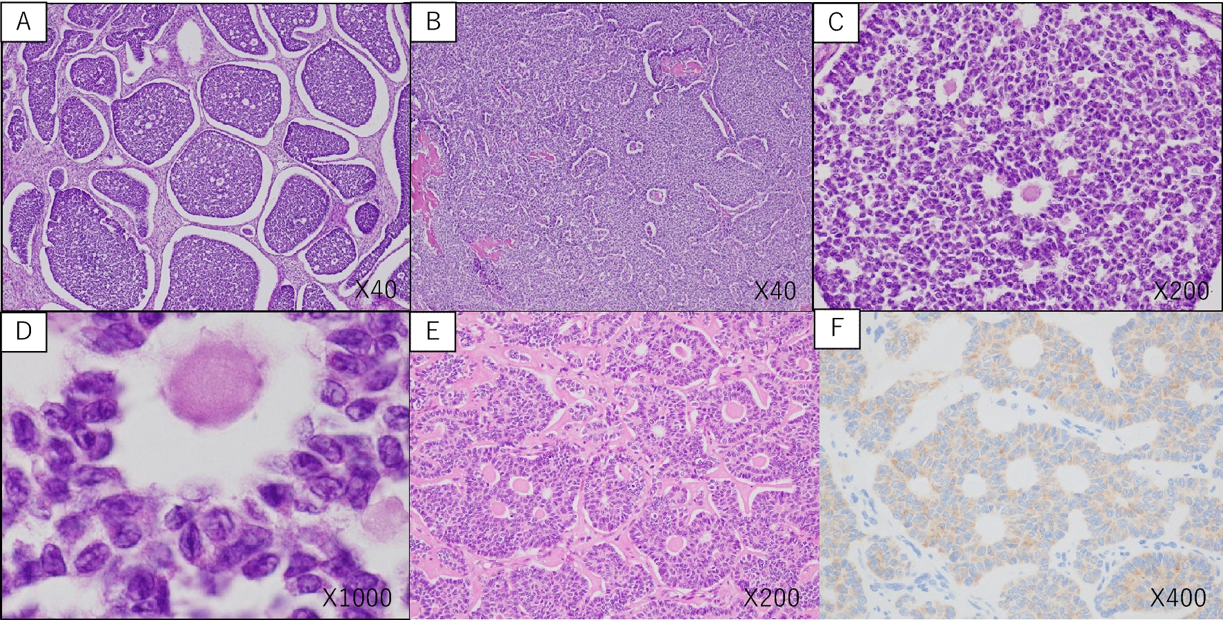 Complete reduction surgery of a huge recurrent adult granulosa cell tumor after neoadjuvant chemotherapy