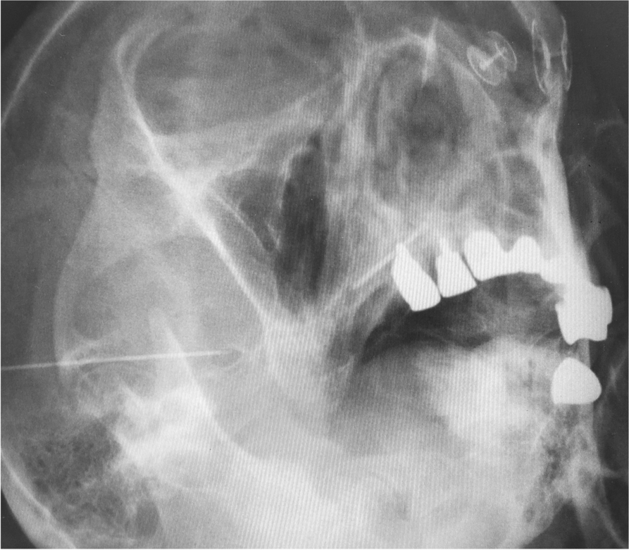 Successful radiofrequency thermocoagulation of the mandibular nerve for intractable pain associated with medication-related osteonecrosis of the jaw: a case report