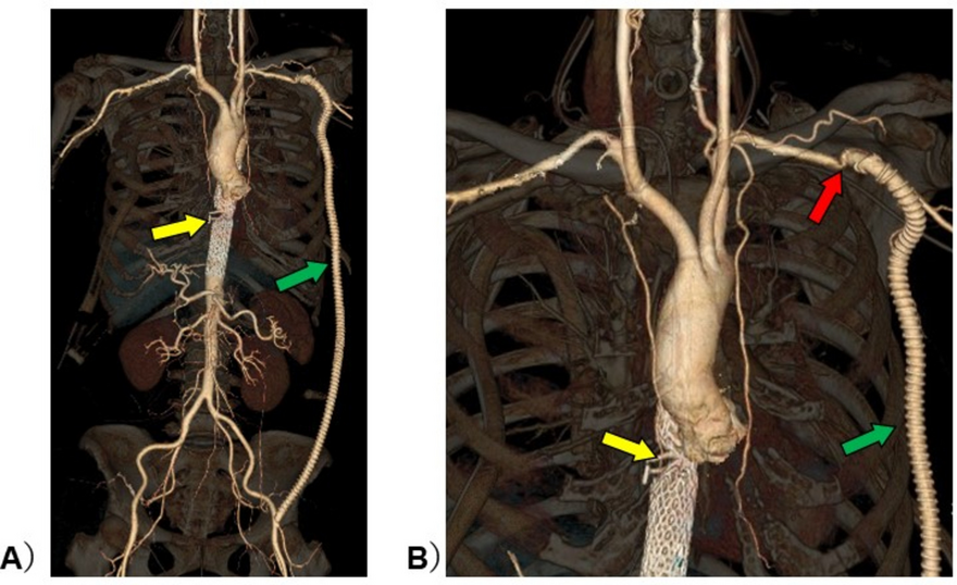Stroke volume variation remains accurate in the presence of proximal stenosis