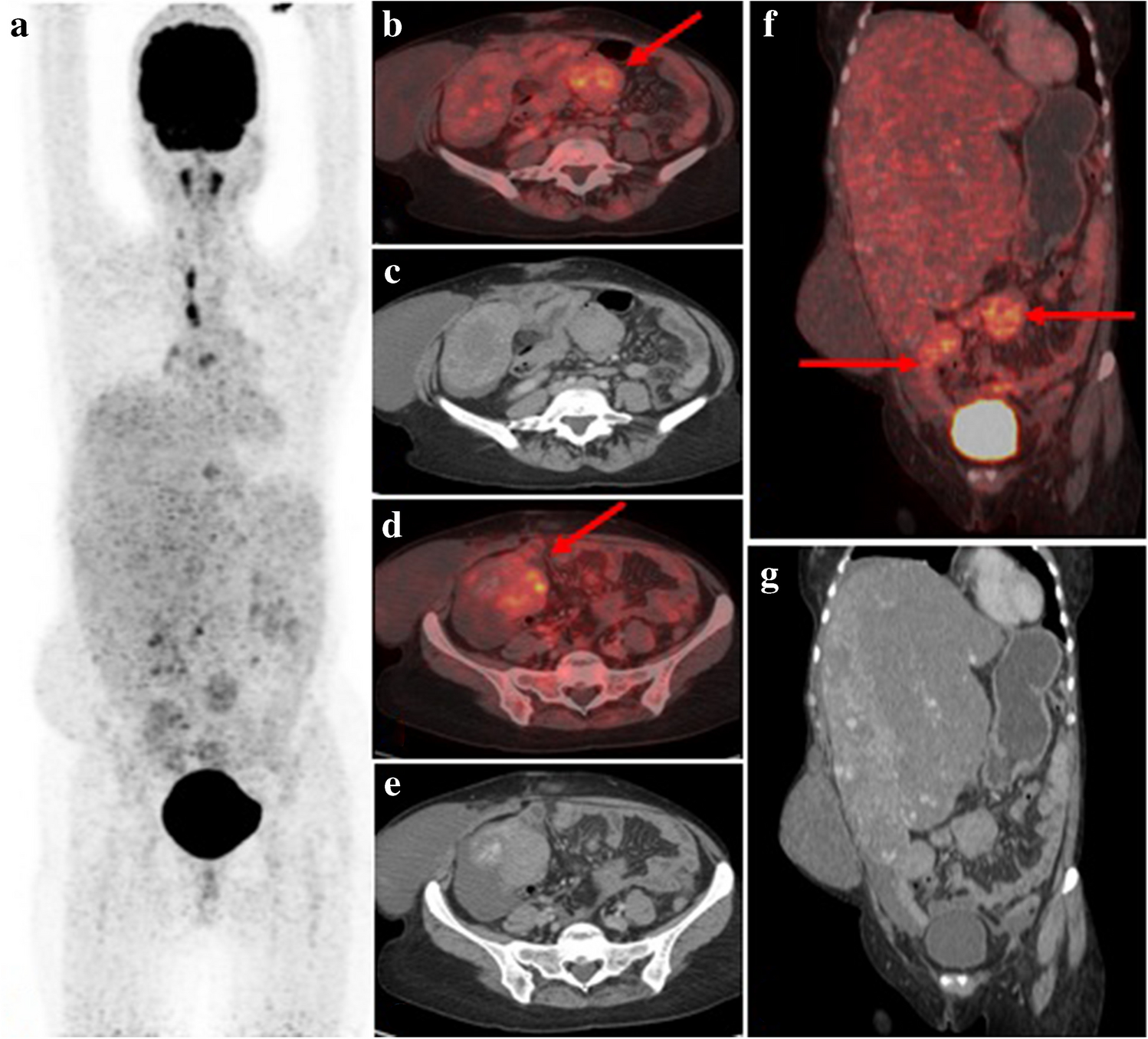 Annotating the Role of 18F-FDG PET/CT in Fibromatoses: A Benign Masquerader of Malignancies—Is It Really an Advantageous Tool?