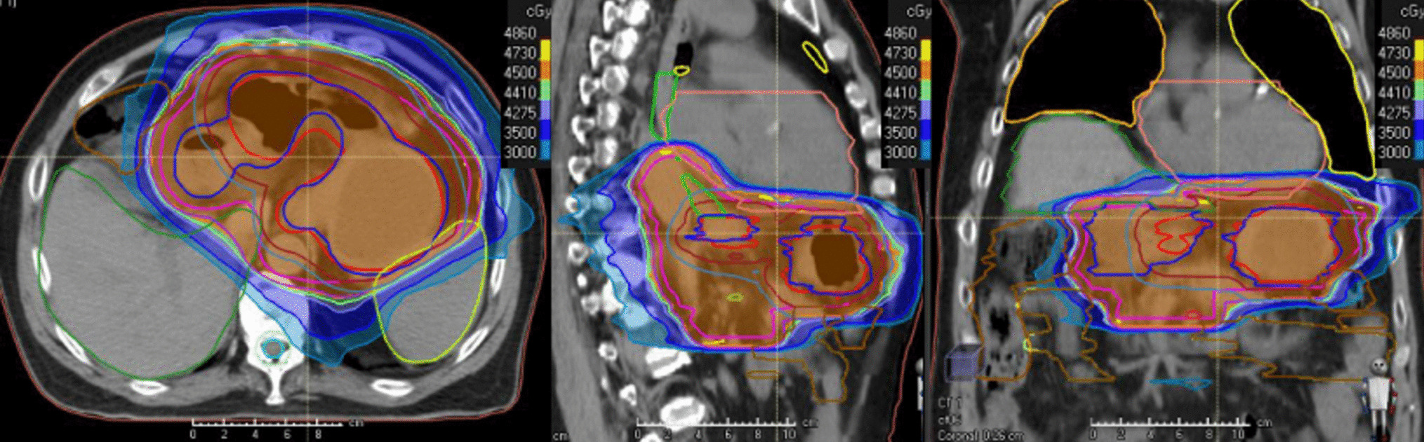 Role of Preoperative Radiation Therapy for Resectable Gastric Cancer