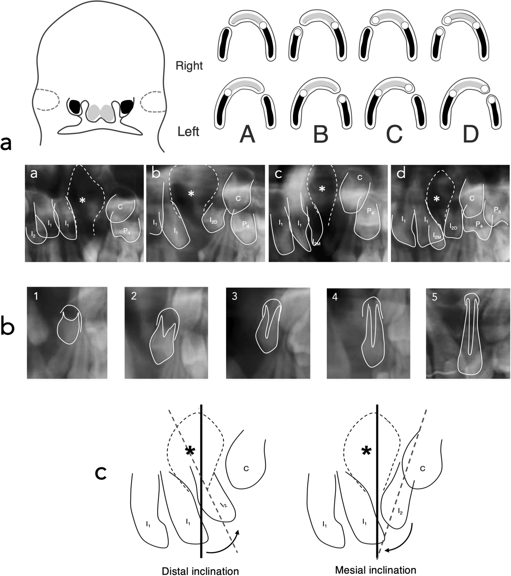 Developmental characteristics of the permanent upper lateral incisor in unilateral cleft lip and palate