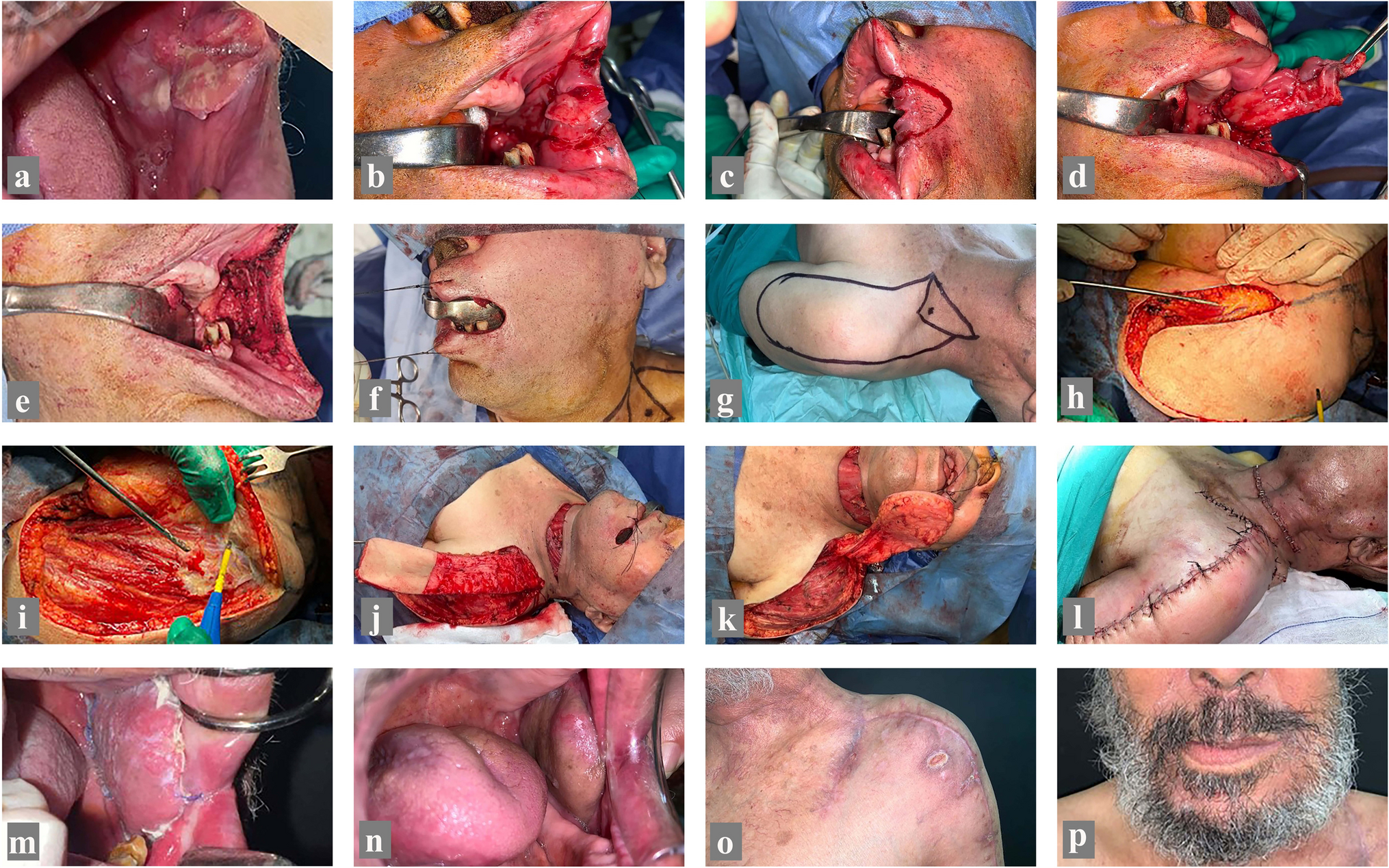 Application of supraclavicular island flap in oral and maxillofacial reconstruction