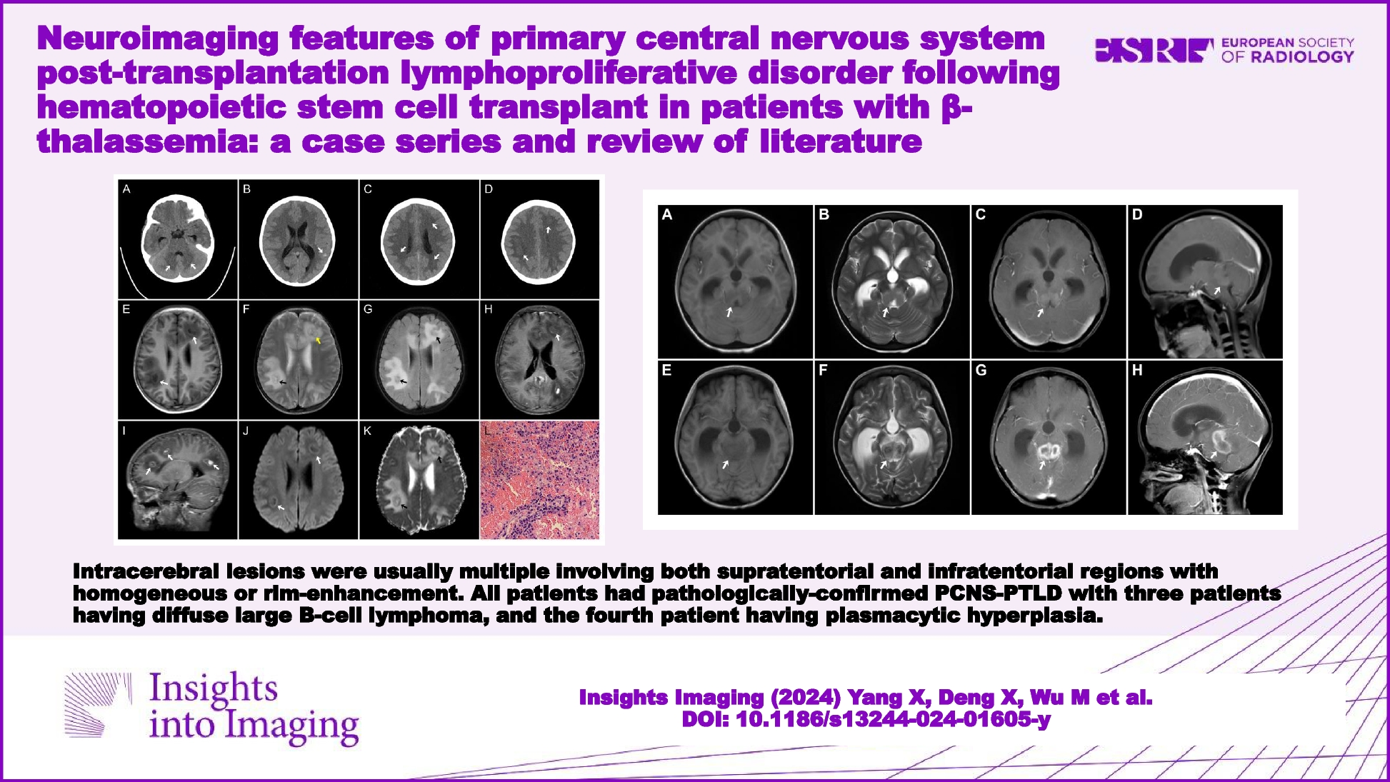 Neuroimaging features of primary central nervous system post-transplantation lymphoproliferative disorder following hematopoietic stem cell transplant in patients with β-thalassemia: a case series and review of literature