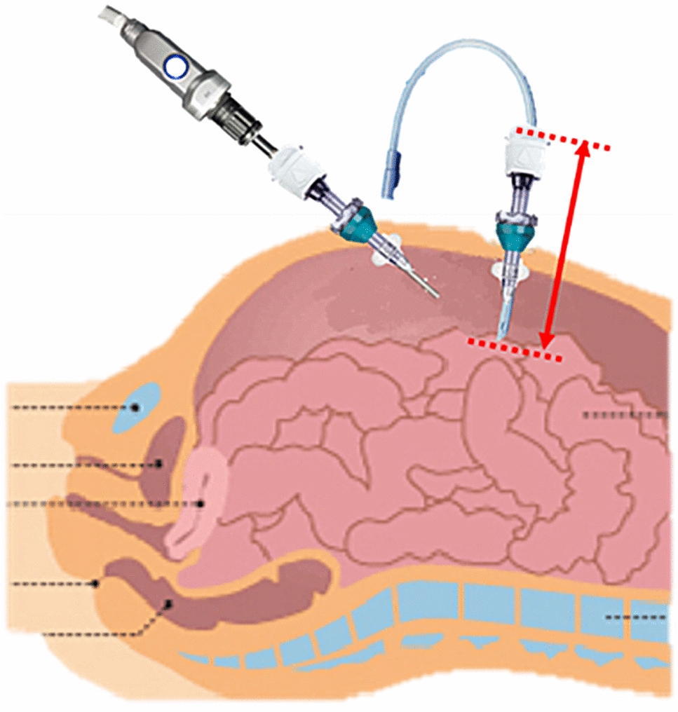 Impact of the combination of abdominal peripheral nerve block and neuromuscular blockade on the surgical space during robot-assisted laparoscopic surgery: a prospective randomized controlled study
