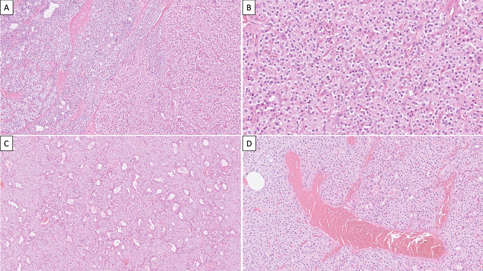 Not All Parafibromin Deficiency Relates to Parathyroid Carcinoma: The Role of Morphological Assessment