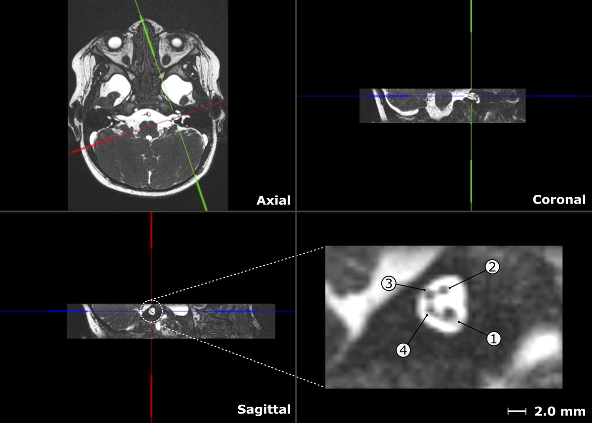 Comparison of Two Measurement Paradigms to Determine Electrically Evoked Cochlear Nerve Responses and Their Correlation to Cochlear Nerve Cross-section in Infants and Young Children With Cochlear Implant