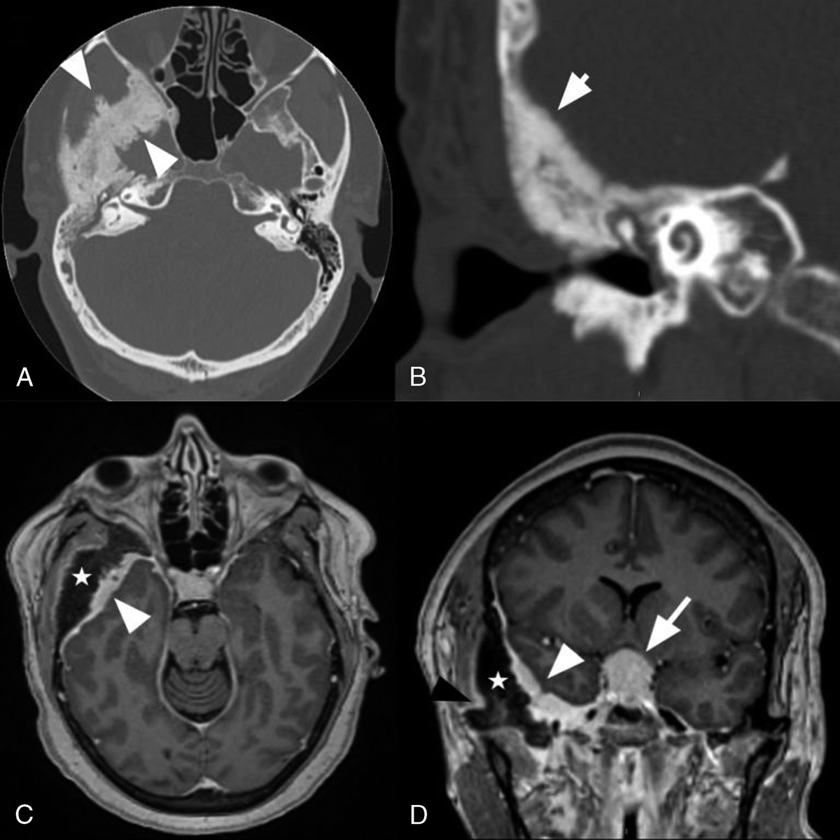 Intraosseous Meningioma Mimicking Fibrous Dysplasia: Imaging Case of the Month