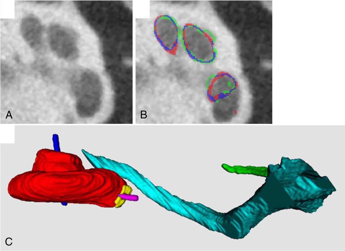 Variability in Manual Segmentation of Temporal Bone Structures in Cone Beam CT Images