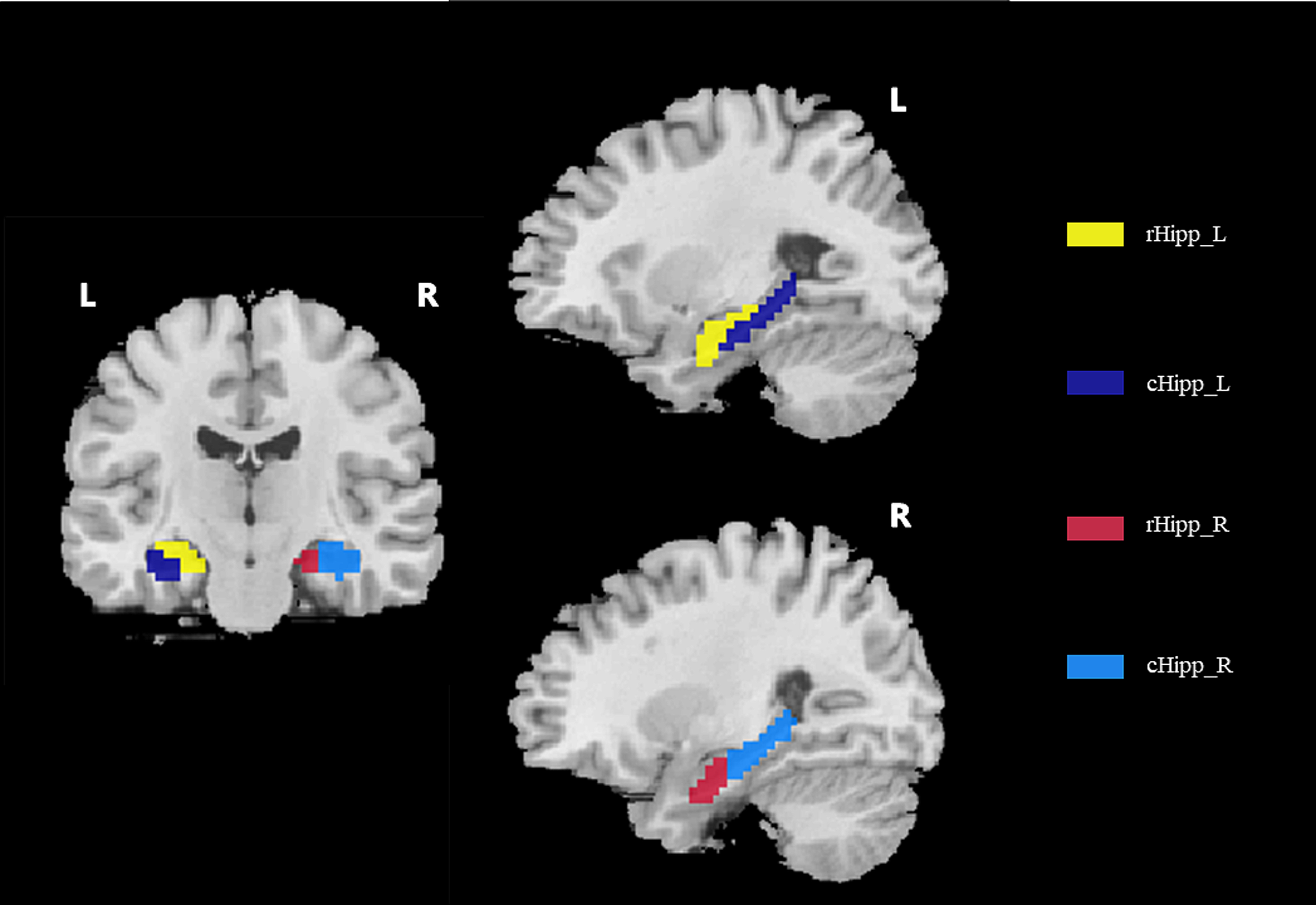 Functional connectivity changes of the hippocampal subregions in anti-N-methyl-D-aspartate receptor encephalitis
