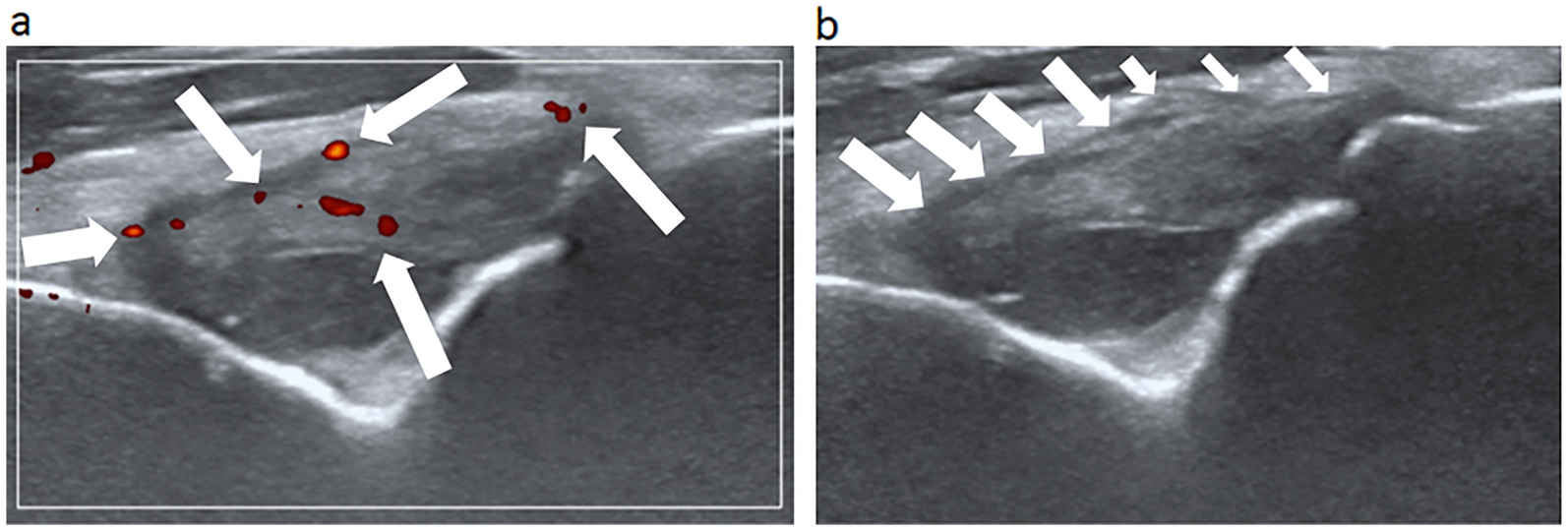 Thermography at the Elbow Among Patients with Rheumatoid Arthritis: A Comparison with Ultrasound-Detected Joint Inflammation Findings