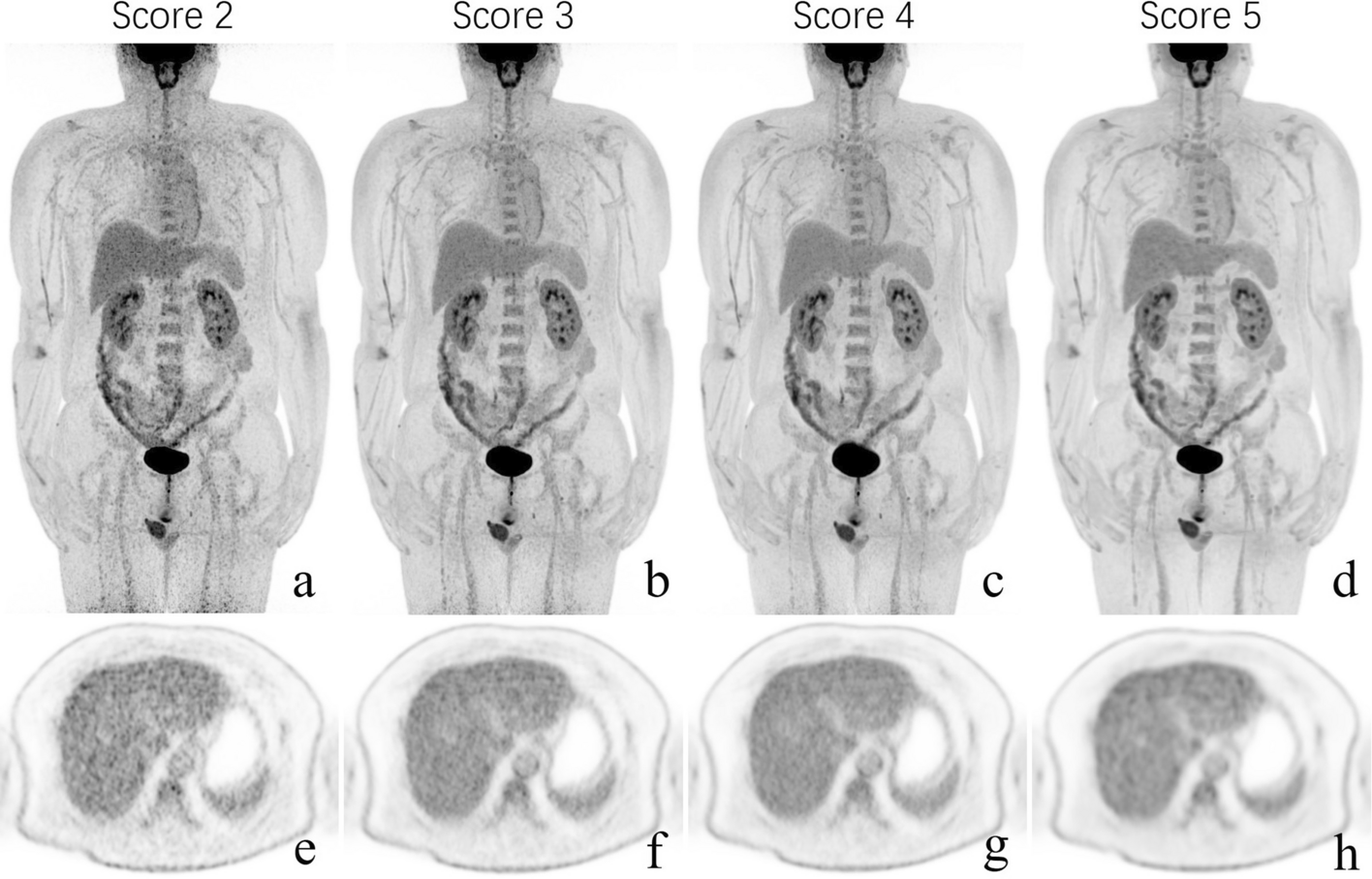 Phantom study and clinical application of total-body 18F-FDG PET/CT imaging: How to use small voxel imaging better?