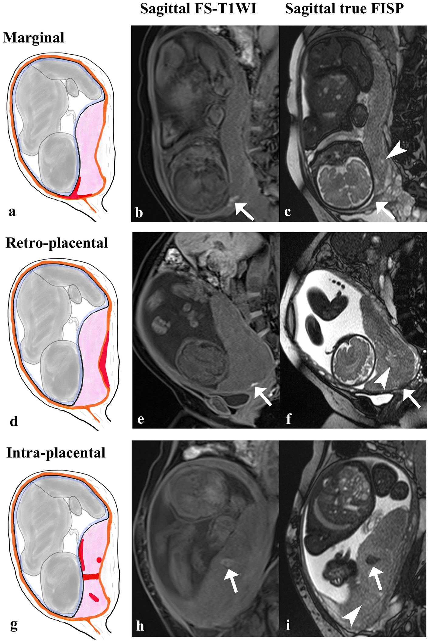Prediction of antenatal bleeding and preterm deliveries using placental magnetic resonance imaging in patients with placenta previa