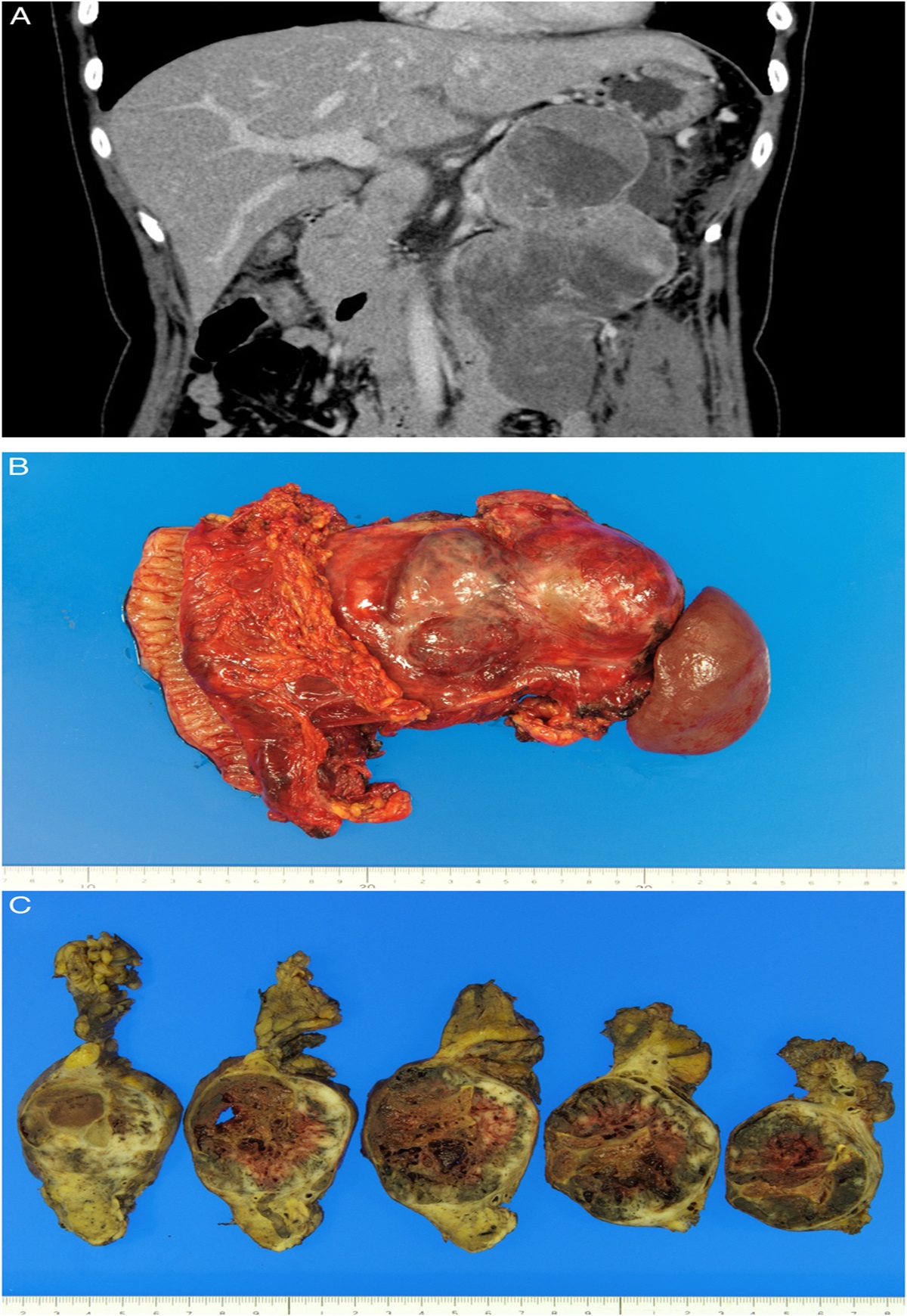 High-grade Solid Pseudopapillary Neoplasms of the Pancreas: Distinct Clinicopathological Malignant Features With Intriguing Gene Alterations through a Comparison With the Conventional Type