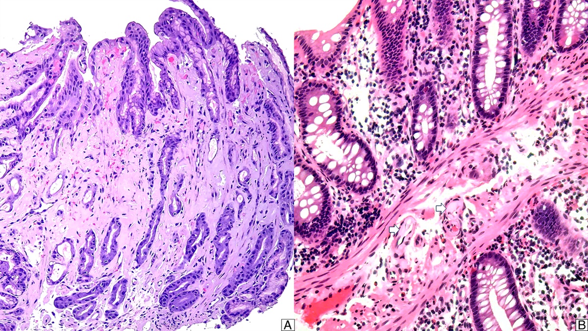Characterization of Amyloidosis in the Gastrointestinal Tract With an Emphasis on Histologically Distinct Interstitial Patterns of Deposition and Misinterpretations