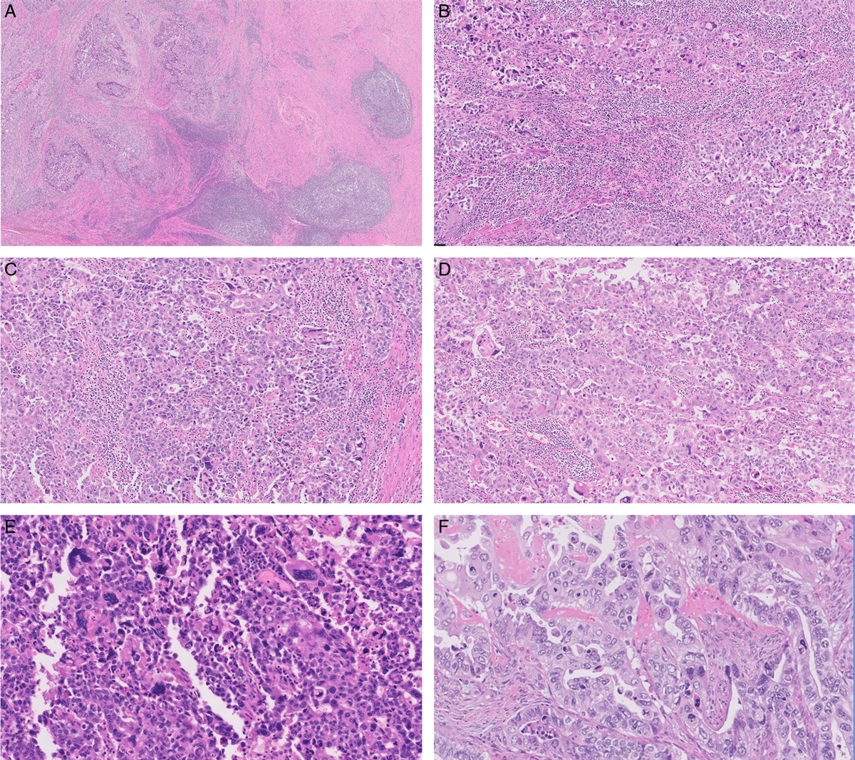 Specific Pathology Features Enrich Selection of Endometrial Carcinomas for POLE Testing
