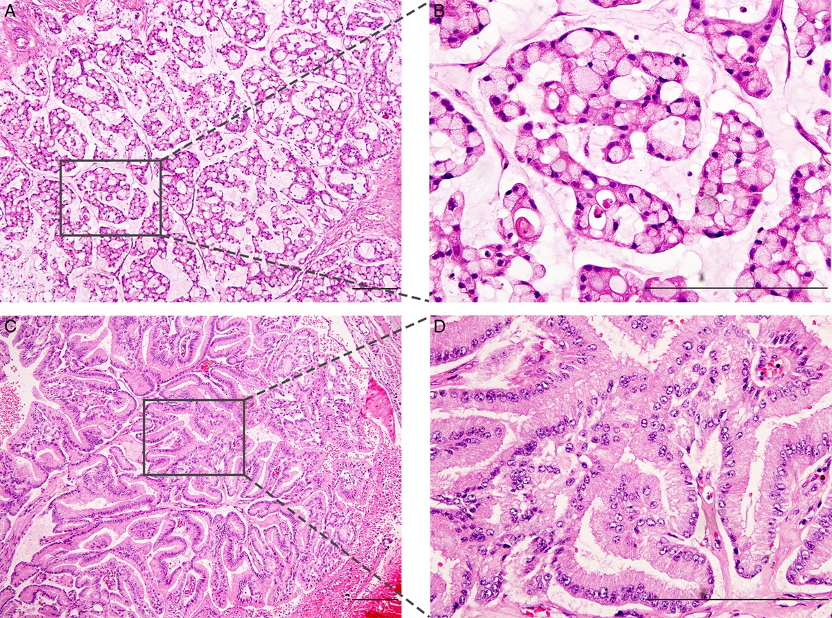 Colloid Pattern of Salivary Mucinous Adenocarcinomas With Recurrent BRAF V600E Mutations