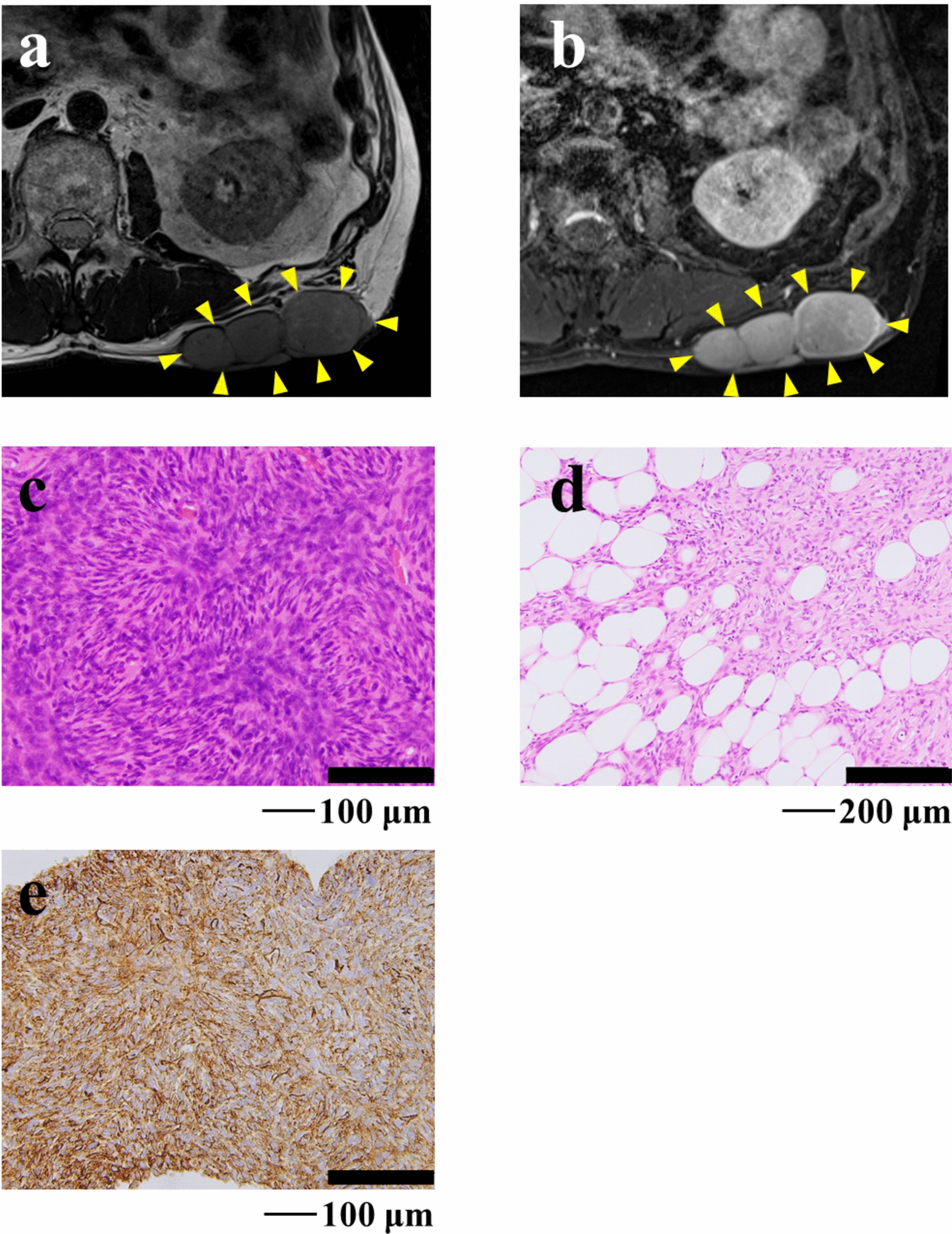 Establishment and characterization of NCC-DFSP5-C1: a novel patient-derived dermatofibrosarcoma protuberans cell line