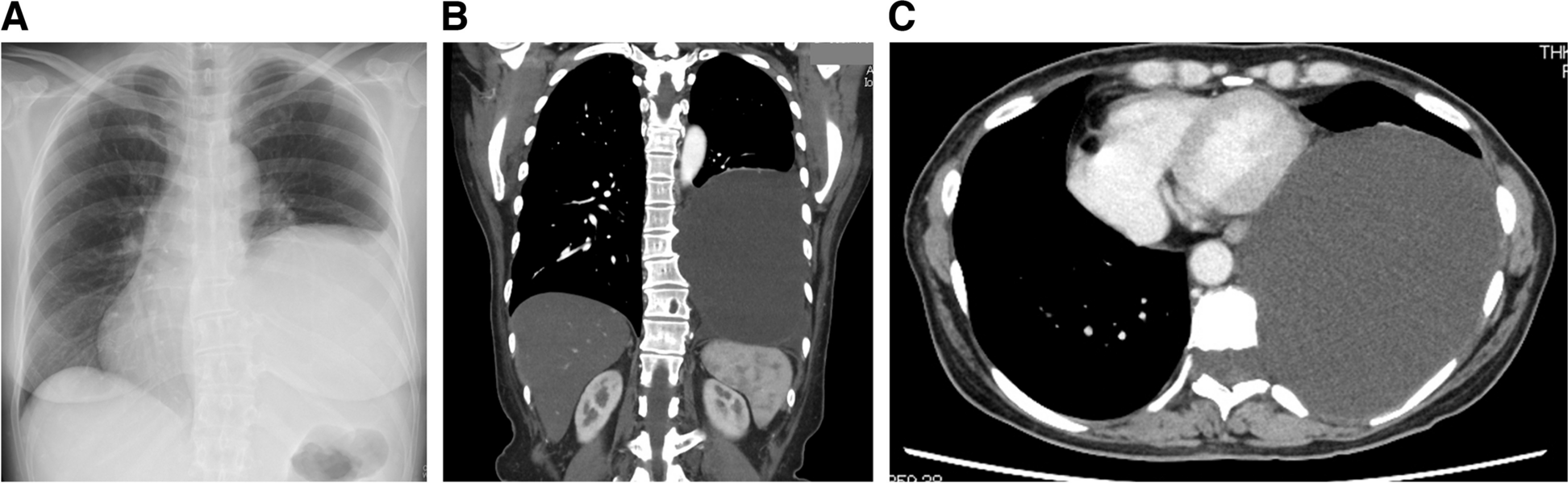 Anesthesia management for thoracoscopic resection of a huge intrathoracic meningocele: a case report