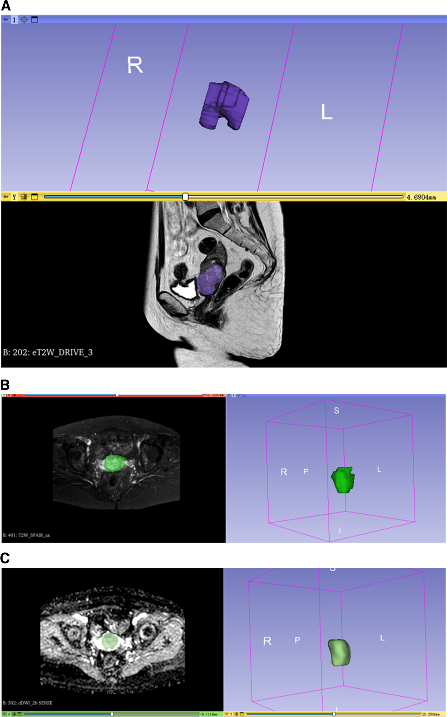 A MRI radiomics-based model for prediction of pelvic lymph node metastasis in cervical cancer