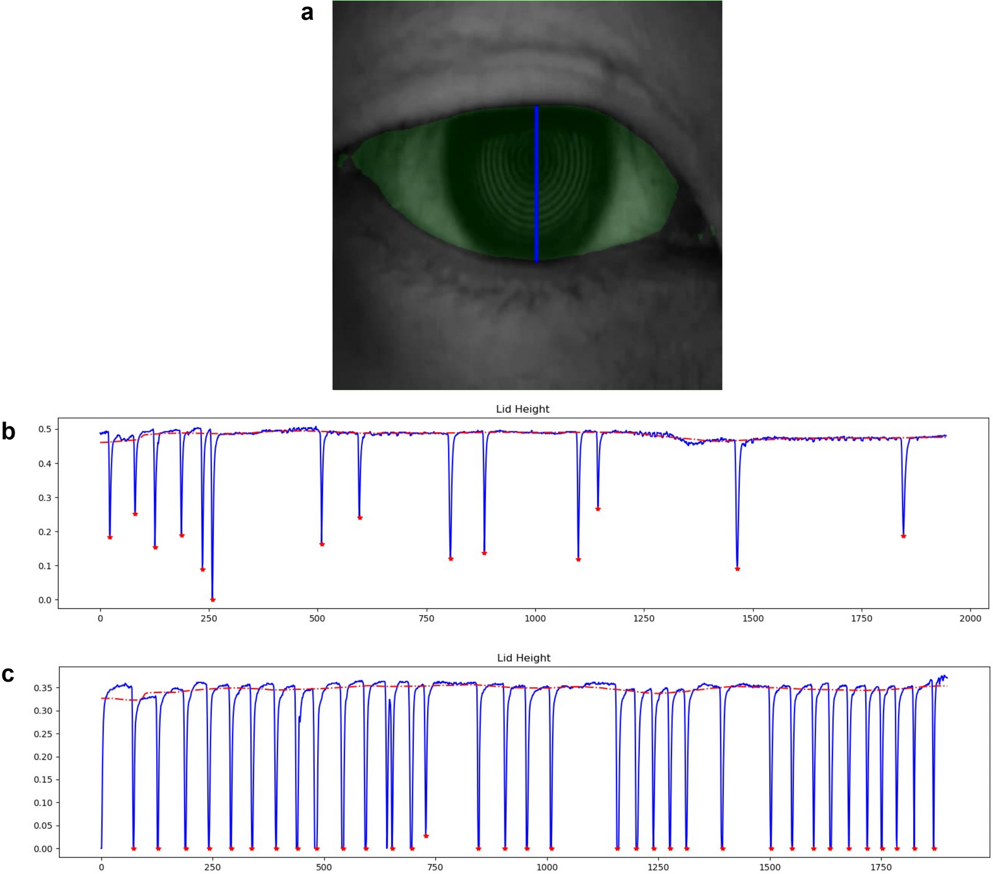 Comparison of deep learning-assisted blinking analysis system and Lipiview interferometer in dry eye patients: a cross-sectional study