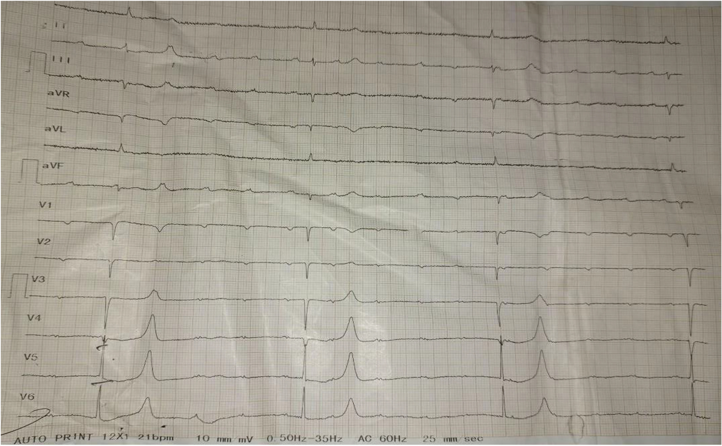 BRASH syndrome with a complete heart block- a case report