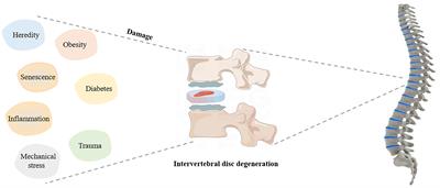 From hyperglycemia to intervertebral disc damage: exploring diabetic-induced disc degeneration