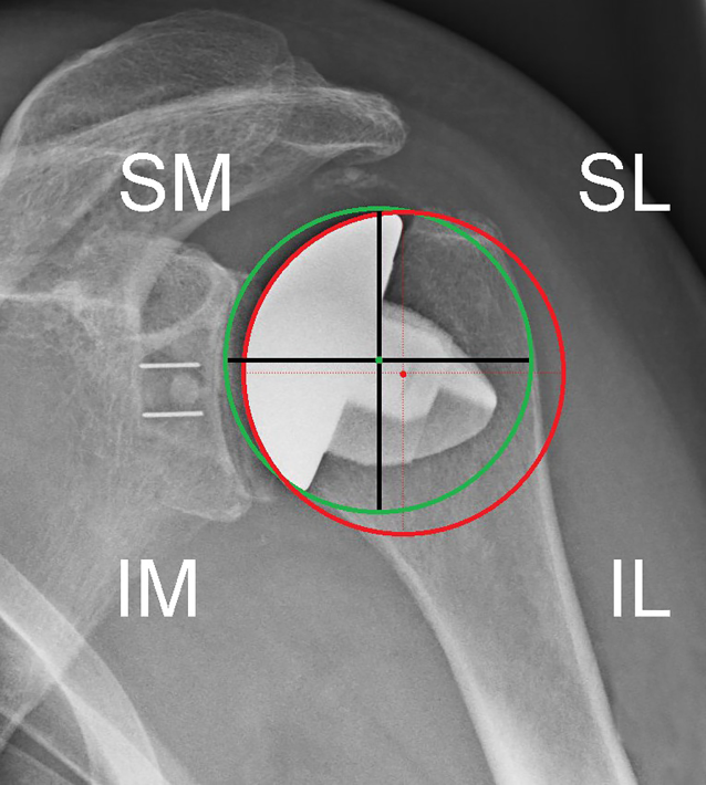 Mid-term results (4–8 years) with the stemless Simpliciti shoulder system