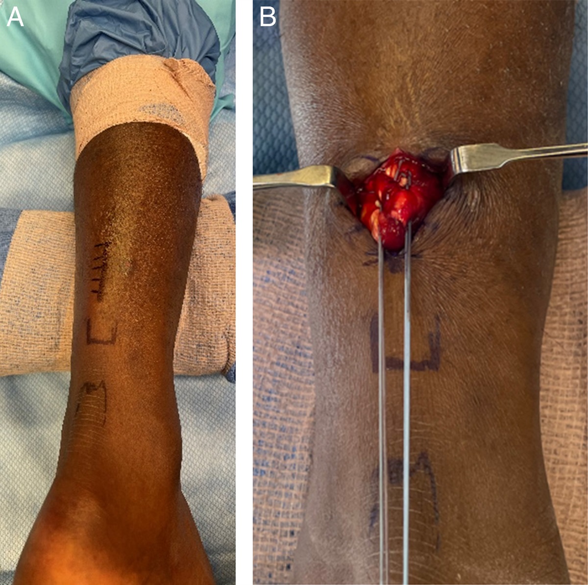 Primary Repair of Achilles Tendon Rupture Using a Mini-incision: A Novel Technique