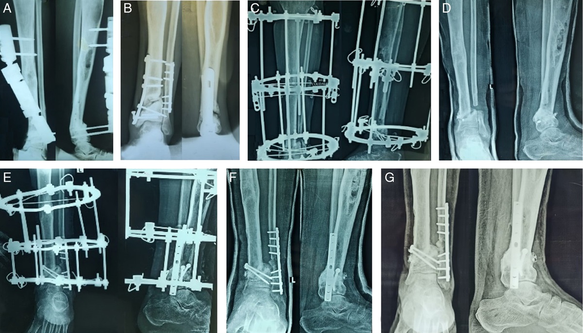Management of Nonunion of Distal Tibial Periarticular Fractures Using Ilizarov External Fixator