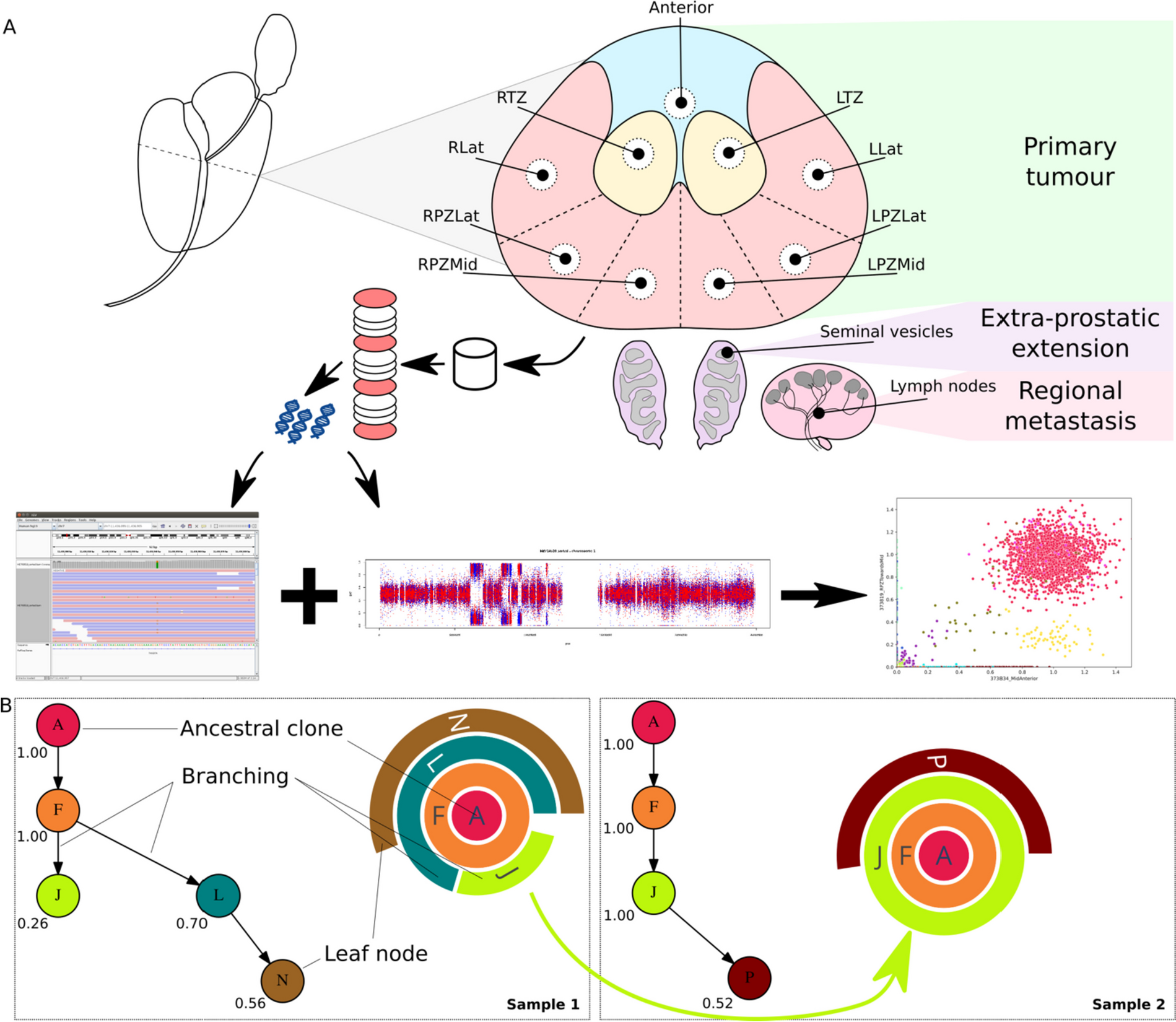 Intra-prostatic tumour evolution, steps in metastatic spread and histogenomic associations revealed by integration of multi-region whole-genome sequencing with histopathological features