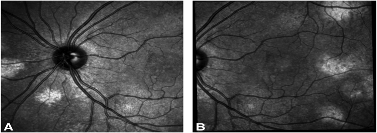 The Relationship Between Choroidal Abnormalities and Visual Outcomes in Pediatric Patients With NF1-Associated Optic Pathway Gliomas