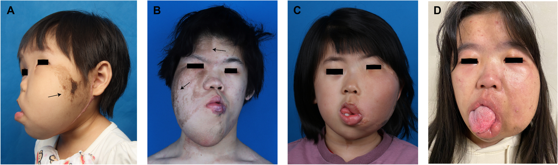 Clinical characteristics and surgical management of facial infiltrating lipomatosis: a single center experience