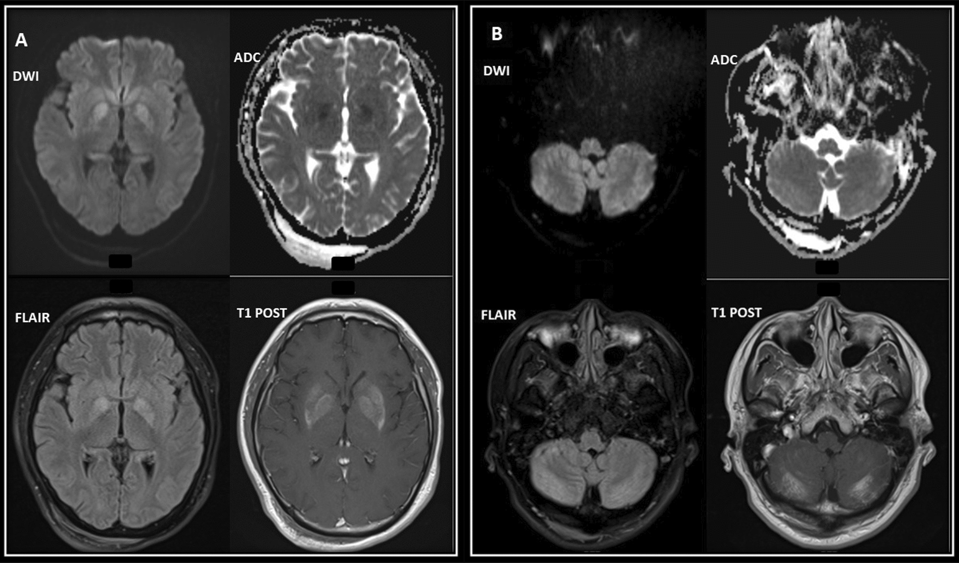 New-onset seizures misdiagnosed as psychogenic non-epileptic seizures: a case of paraneoplastic limbic encephalitis with primary testicular cancer