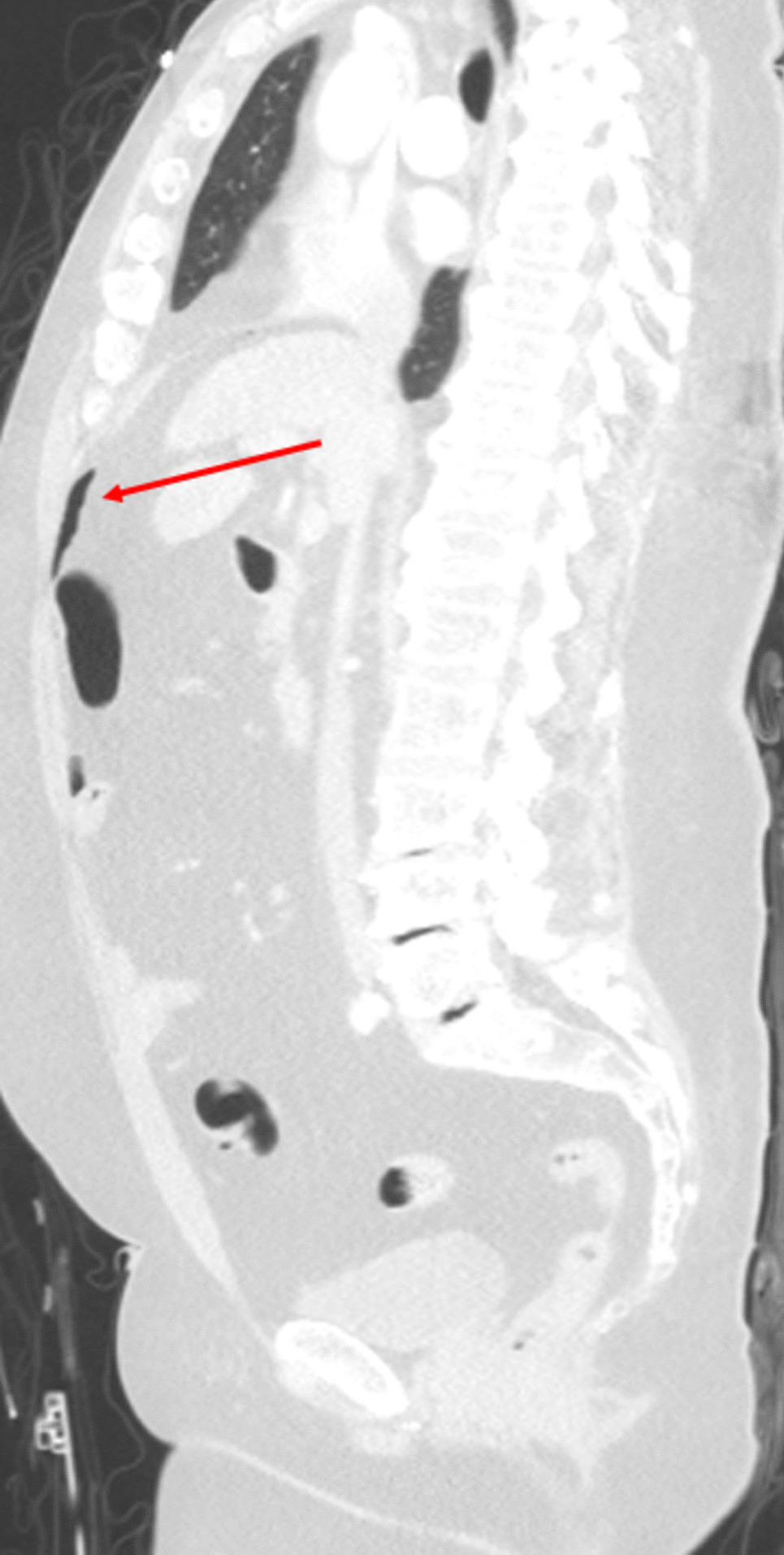 Abdominal computed tomography scoring systems and experienced radiologists in the radiological diagnosis of small bowel and mesenteric injury