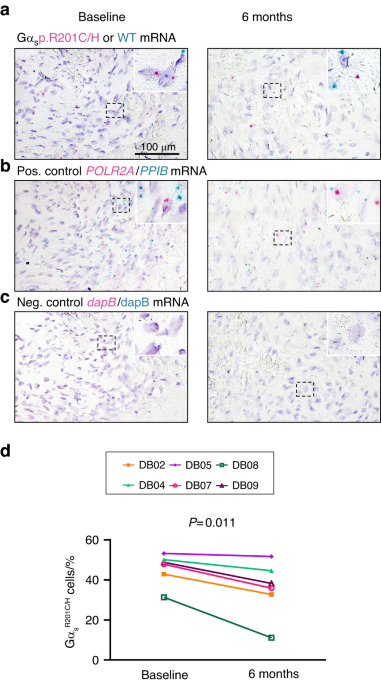 RANKL inhibition reduces lesional cellularity and Gαs variant expression and enables osteogenic maturation in fibrous dysplasia