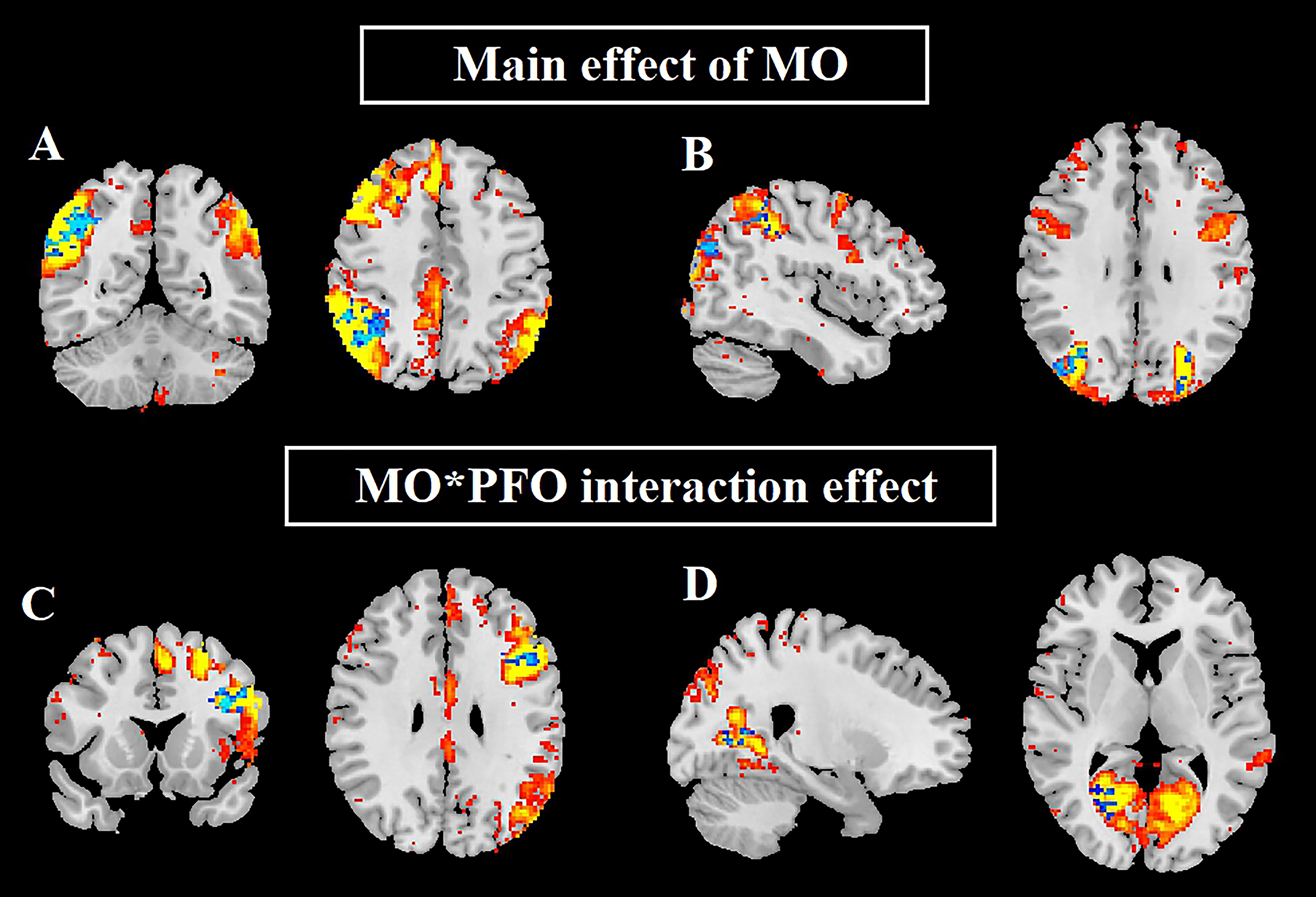 Association between patent foramen ovale and migraine: evidence from a resting-state fMRI study