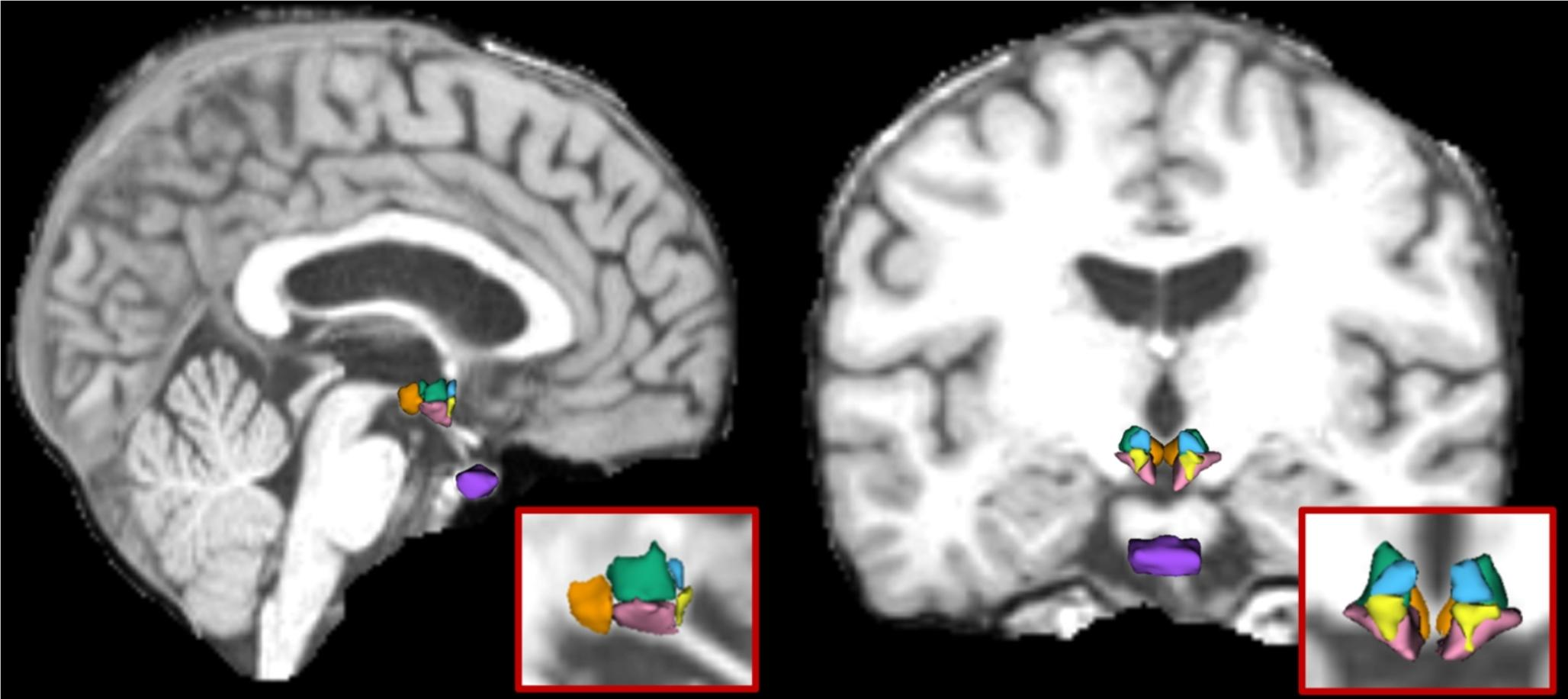 Smaller hypothalamic subregion with paraventricular nucleus in patients with panic disorder